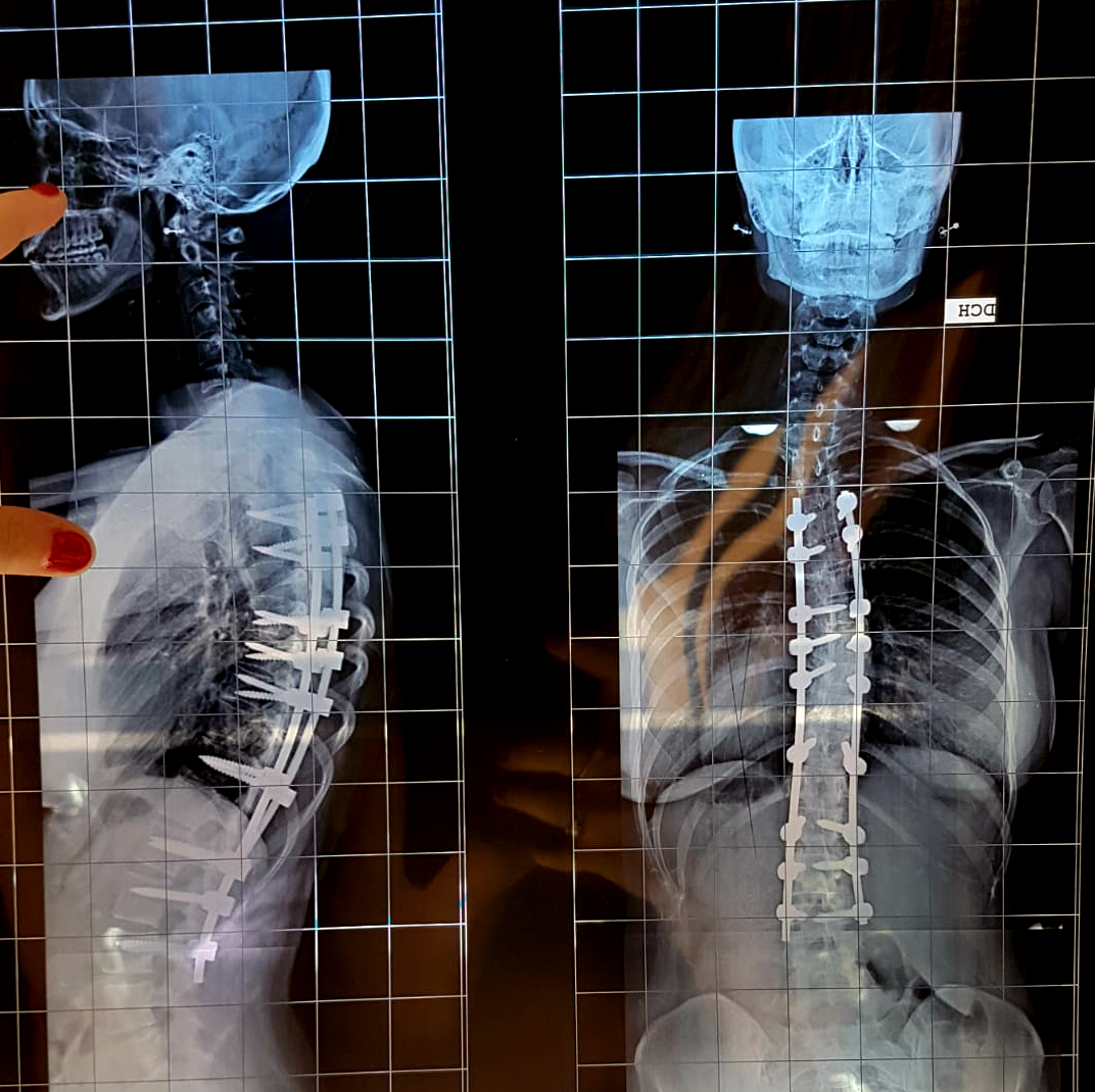 Corrección columna radiografía